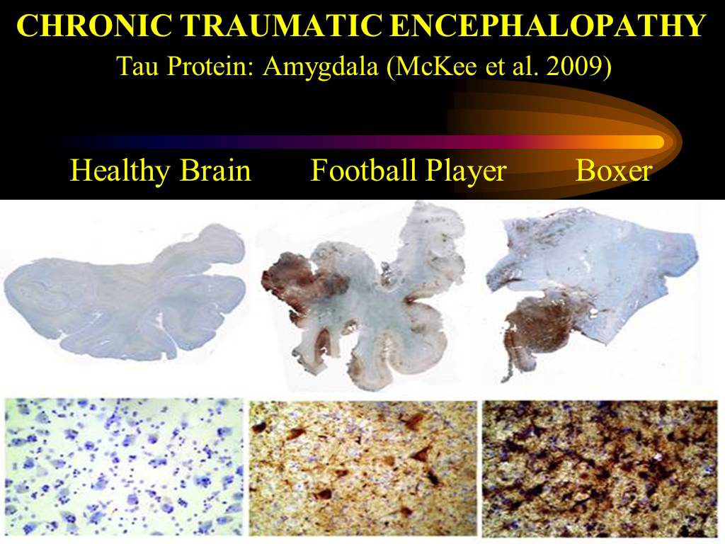 unionizing to prevent cte 1, Chronic Traumatic Encephalopathy in contact sports